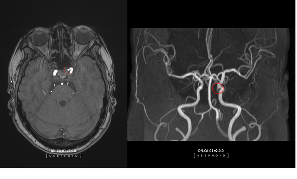 딥노이드의 뇌동맥류 뇌영상검출·진단보조소프트웨어 '딥뉴로(DEEP:NEURO)'가 지난 14일 한국보건의료연구원(NECA)의 최종 평가를 통해 혁신의료기술로 선정됐다. 이에 따라 딥노이드는 한시적 비급여 대상으로 임상시장 진입이 가능해졌다.